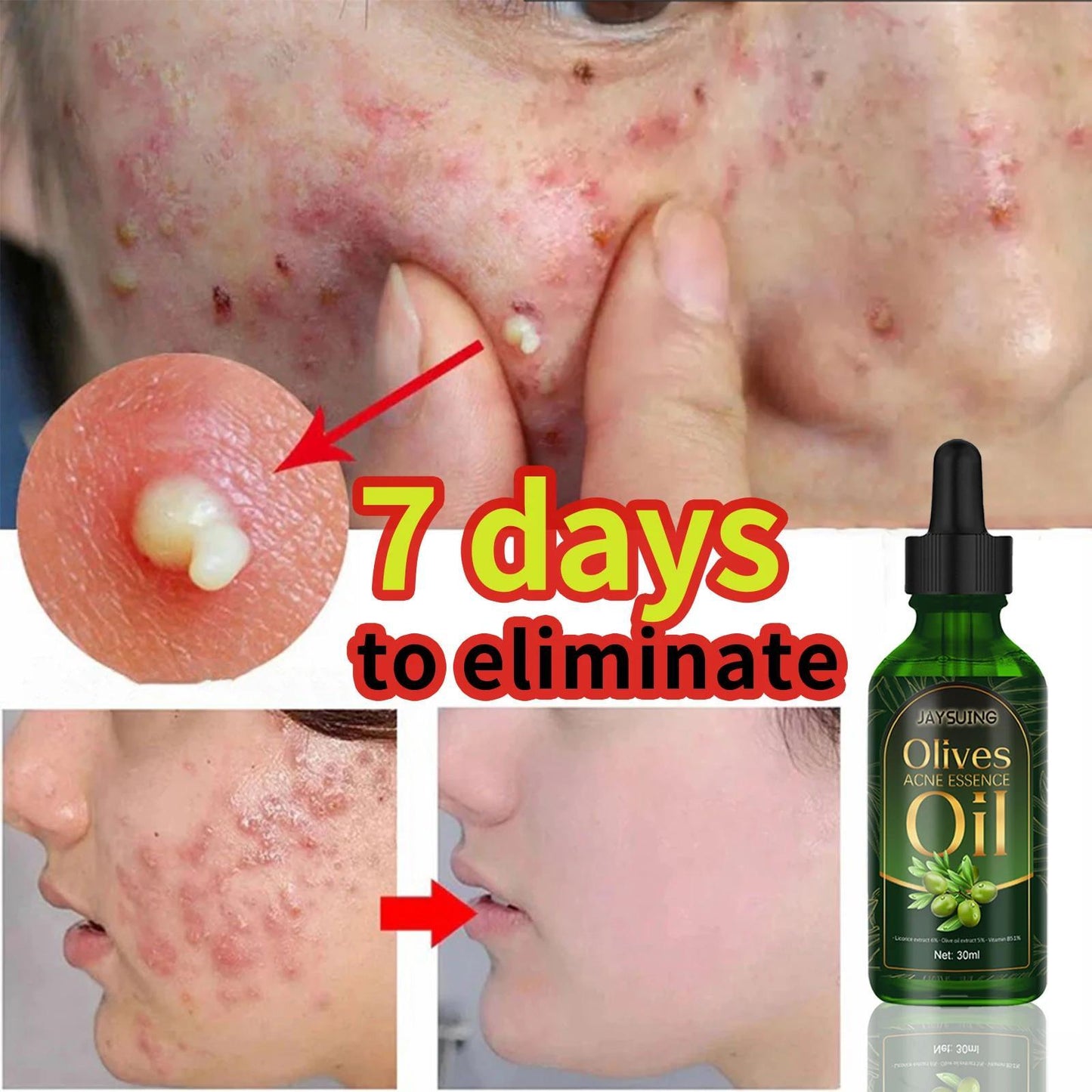 Remove Face Oil Acne Gentle Moisturizing Acne Pit Repair Liquid Fade Face Acne Marks Essential Oil